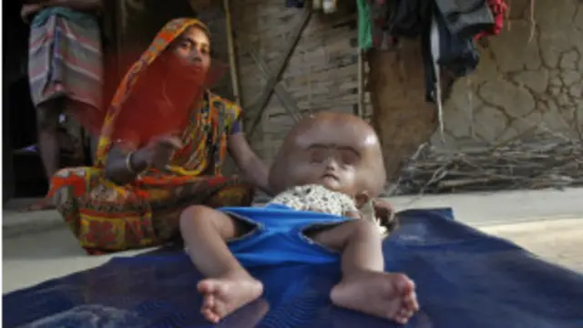 रुना बेगम के मुफ्त इलाज के लिए सामने आया गुड़गांव का एक अस्पताल.