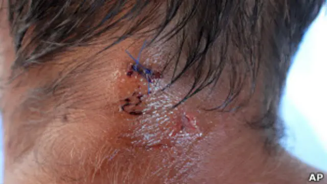 Mordedura de cocodrilo