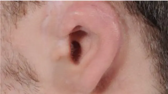 دا ډول غوږونه د ماشوم له لويېدو سره سمه وده کوي. 