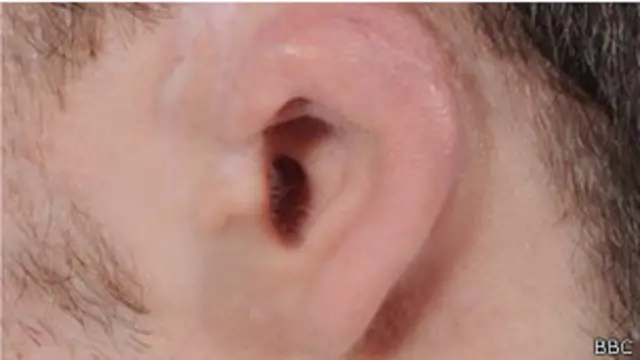 orelha de Brian Hogg (foto: BBC)