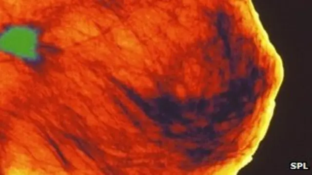 لاحظ الباحثون زيادة كبيرة في معدلات عودة السرطان لمهاجمة السيدات بعد مضي خمس سنوات على إصابة المريضات الأصغر سنا