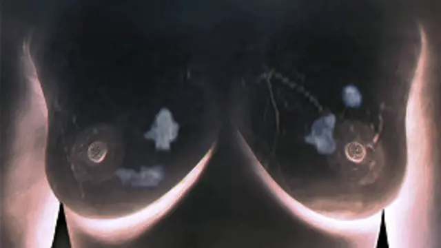 स्तन कैंसर