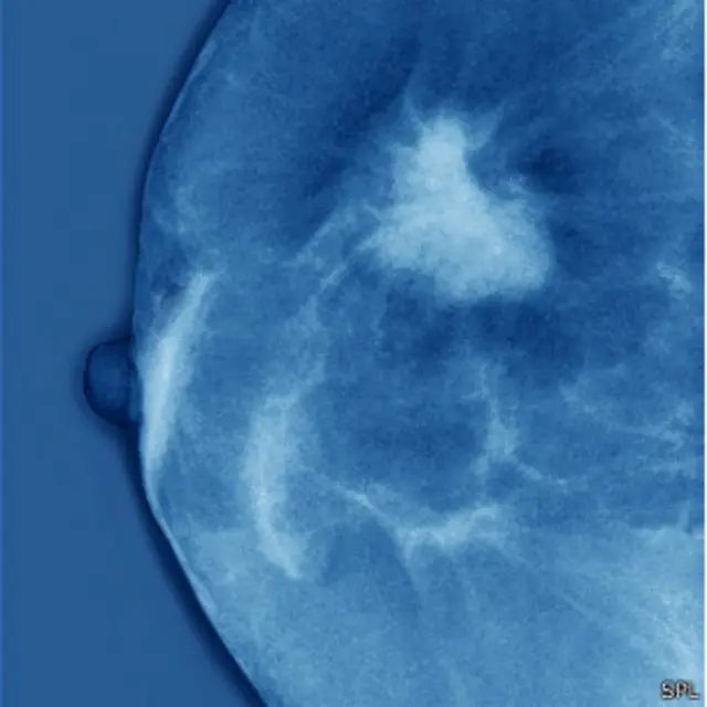 tumor na mama (foto: SPL)