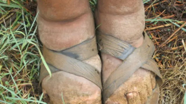 Ugonjwa wa Matende husababisha ulemavu