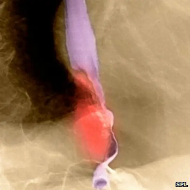 рак пищевода