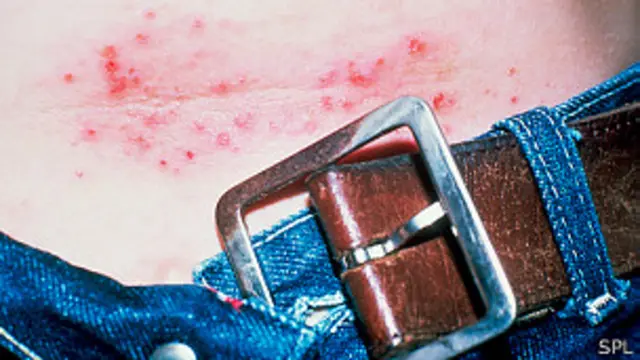 Reacción alérgica al níquel