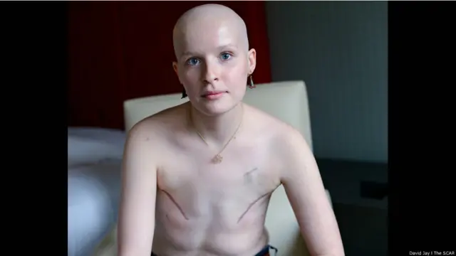 Eliza © David Jay/The SCAR Project