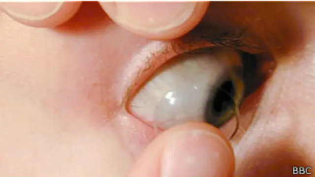 Lentes de contacto telescopicos deals