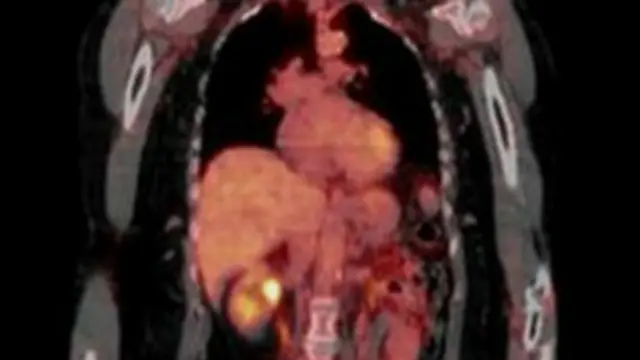 फेफड़े का कैंसर