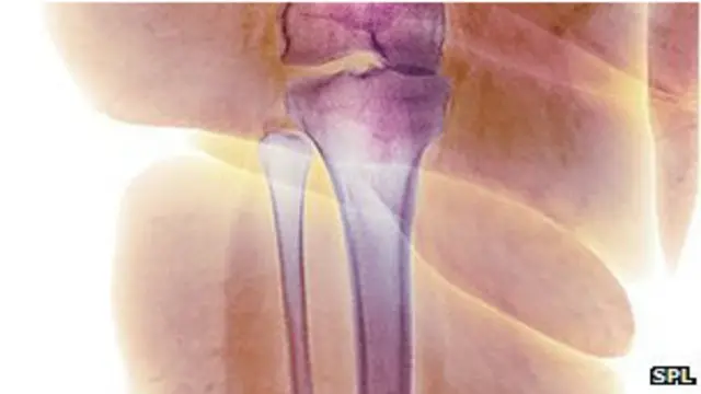 هغه کسان چې له دغې ناروغۍ سره مخامخ کېږي، د هغو د هډوکو به مغز کې ډېر غوړ وموندل شول. 