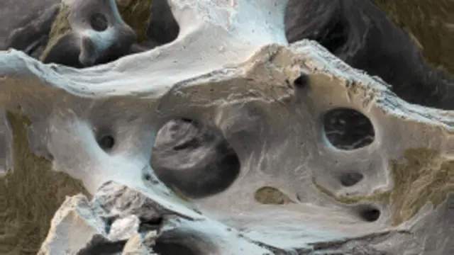 پوکی استخوان