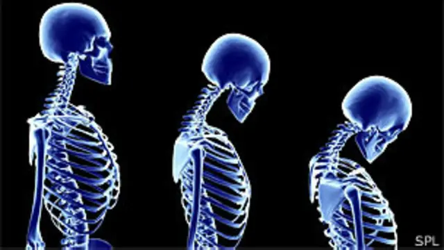 Imagem gerada por computador mostra a progressão da osteoporose em um esqueleto feminino (SPL)