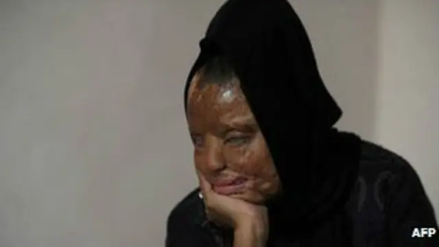 Una mujer con el rostro quemado