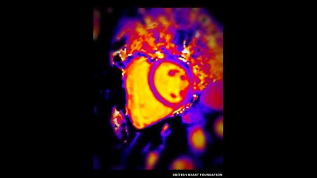 यह तस्वीर गुर्दा दान देने वाले एक स्वस्थ व्यक्ति के दिल की है.