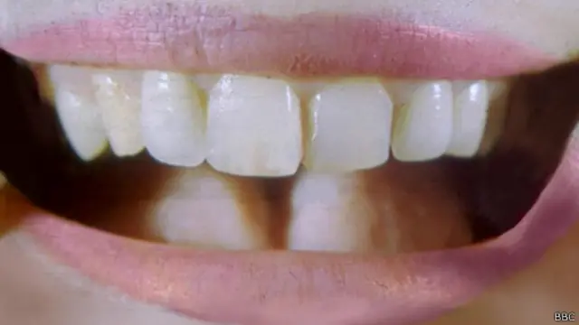 Dente humano | Foto: BBC