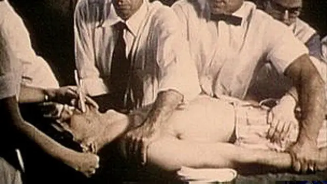 Paciente sometido a un electrochoque.