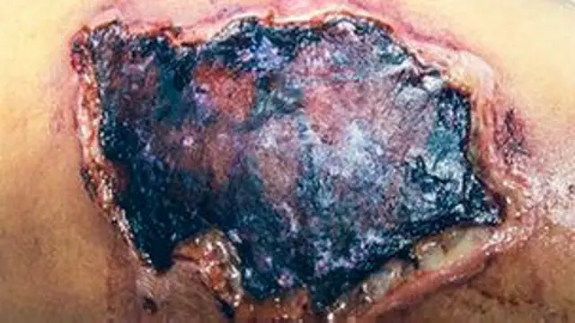 Herida causada por la araña parda reclusa