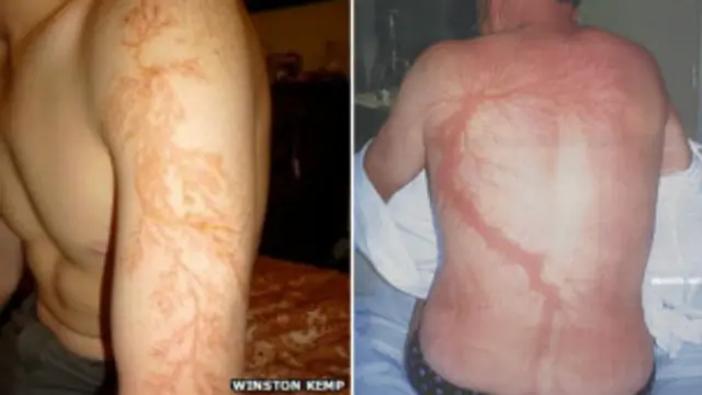 लाइटनिंग ट्री