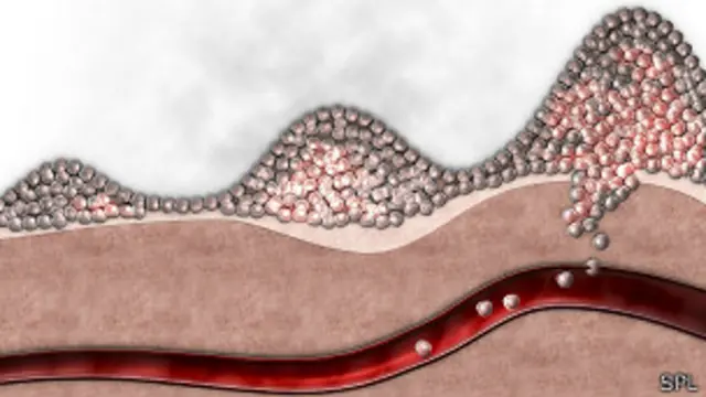 Desarrollo de un cáncer