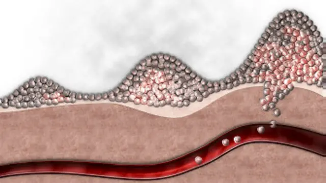 कैंसर के बहुत सारे रूप हैं लेकिन उनके कारणों का पता अब भी नहीं है