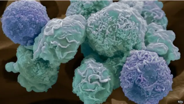 अल्ट्रा वायलेट रेडियेशन और धूम्रपान डीएनए में बदलाव पैदा करते हैं जो कैंसर का रिस्क बढ़ाता है 