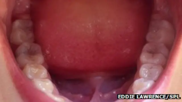 فوسوباکتری که عموما در دهان موجود است ژن‌های رشد سرطانی را به کار می‌اندازد