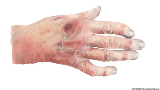 दिल के दौरे के शिकार बुजुर्ग मरीज़ का हाथ