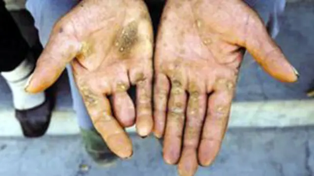 يسبب التسمم بالزرنيخ اضرارا مختلفة وخطيرة