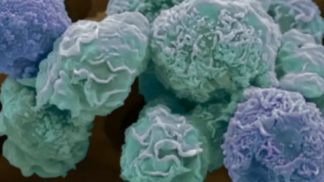 سلول های سرطانی