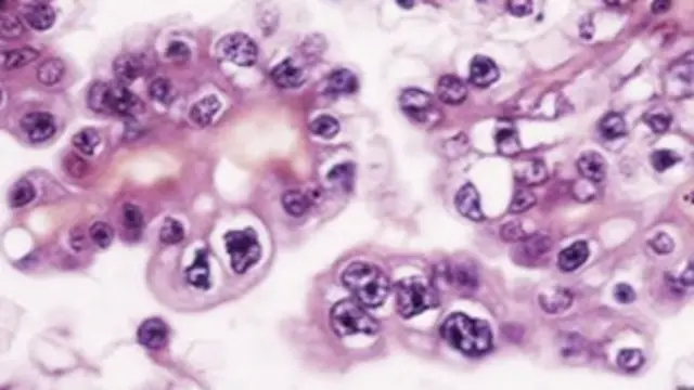 محققین کے مطابق خواتین کے بیض دانی میں سرطان کی موجودگی کا جلد پتہ چلنے سے 90 فیصد تک خواتین کی زندگی بچائی جا سکتی ہے