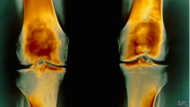 शोधकर्ताओं का मानना है कि खूब सारी ब्रोकली खाने से गठिया की बीमारी ठीक हो सकती है