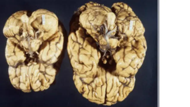 Cerebro microcefálico