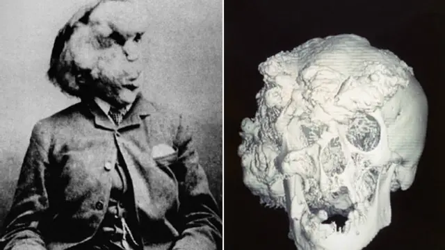 एलिफेंट मैन