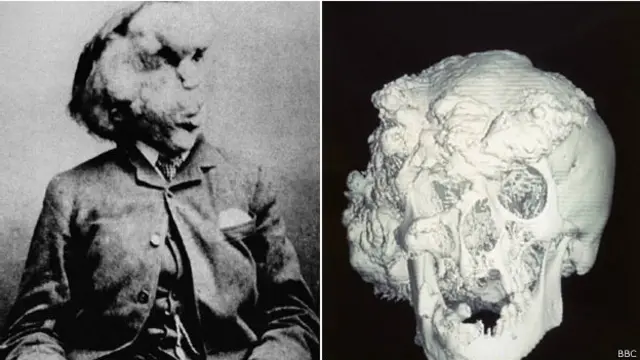 Imagens do 'homem elefante' | Foto: arquivo BBC