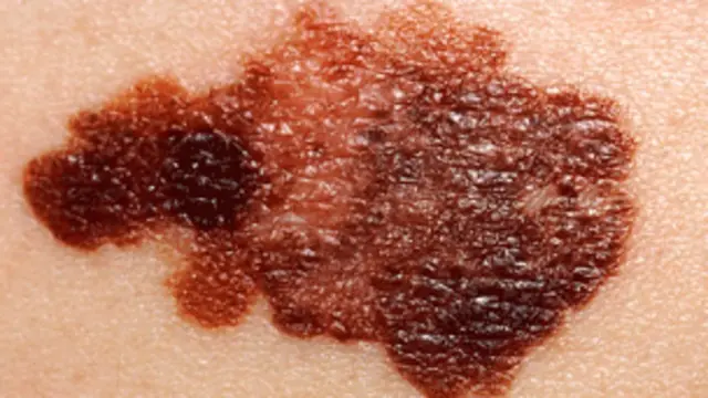 الميلانوما اخطر انواع سرطان الجلد