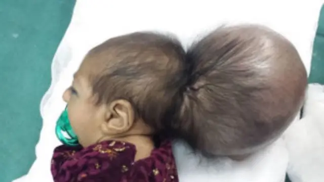 عمليات شوې ماشومه 