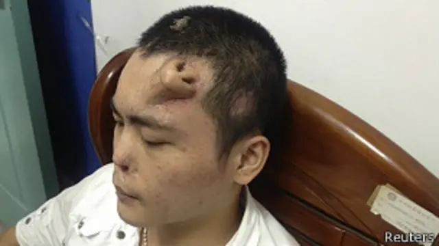 أنف المريض، تشاوليان