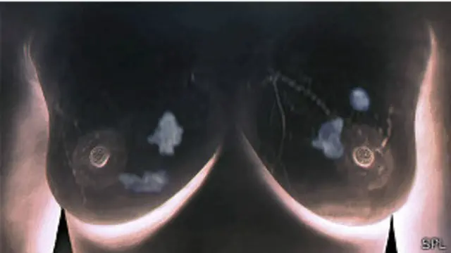 स्तन कैंसर