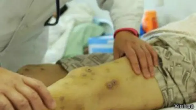 206 लोगों का अभी भी अस्पताल में इलाज चल रहा है.