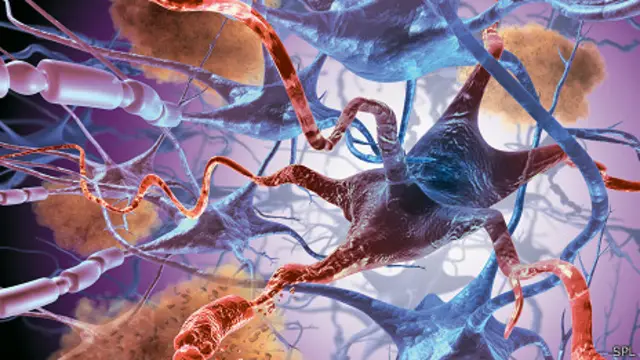 Клетки с болезнью Альцгеймера