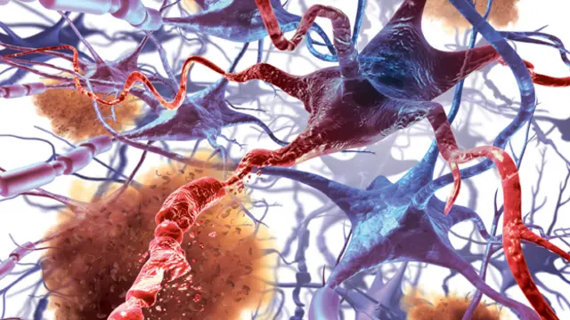 رسم تخطيطي لموت خلايا دماغية جراء مرض الزهايمر