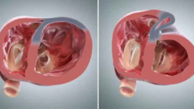 दिल का मॉडल