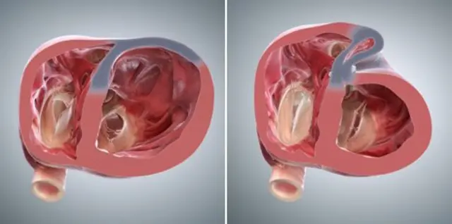 دل میں سکار ٹشوز خاکستری رنگ میں