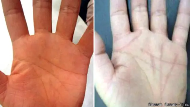 Producto de la operación de las manos en la clínica de Shonan