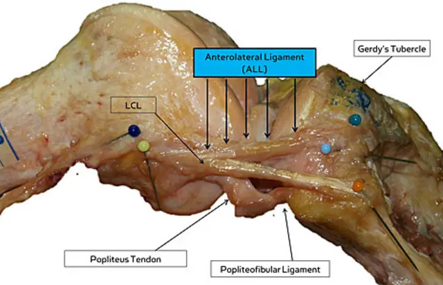محقیقین نے 41 گھٹنوں کے باریک مطالعے سے نئے نسیج یا لیگامنٹ کی پہچان کی ہے
