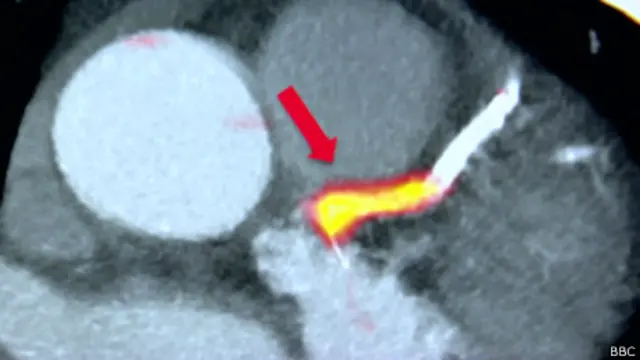 Imagem de um coração, com químico radioativo em laranja. Foto: BBC