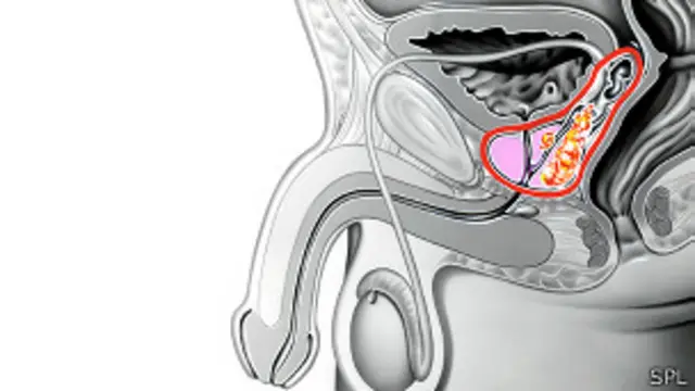 Cáncer de próstata