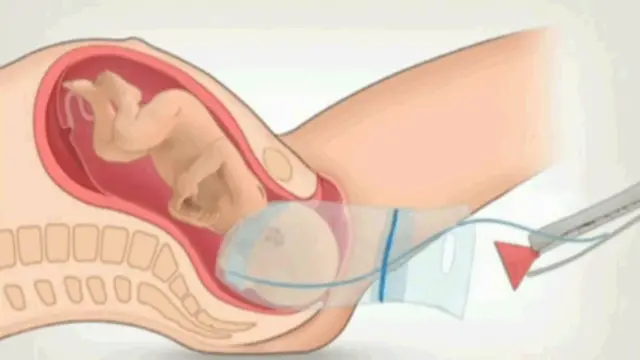 سیزیریئن قانون کے ساتھ برازیل میں اس کے متعلق ایک مہم بھی جاری ہے جس میں کہا جا رہا ہے کہ ’بچے کی ولادت معمول کی بات ہے‘