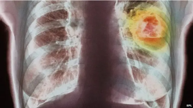 फेफड़े का कैंसर