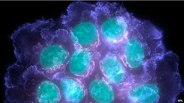 स्तन कैंसर